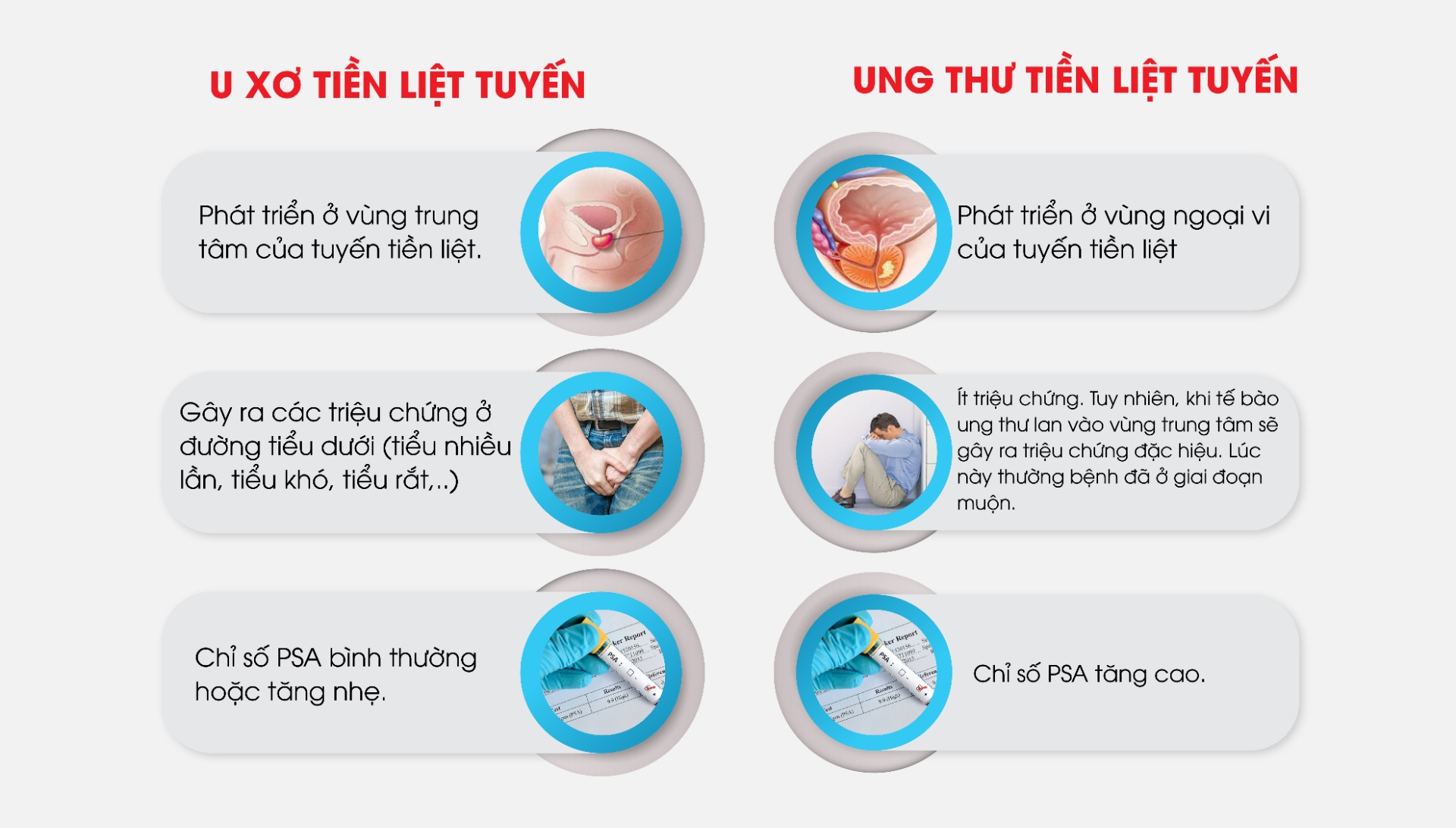 Phân biệt u xơ tiền liệt tuyến và ung thư tiền liệt tuyến
