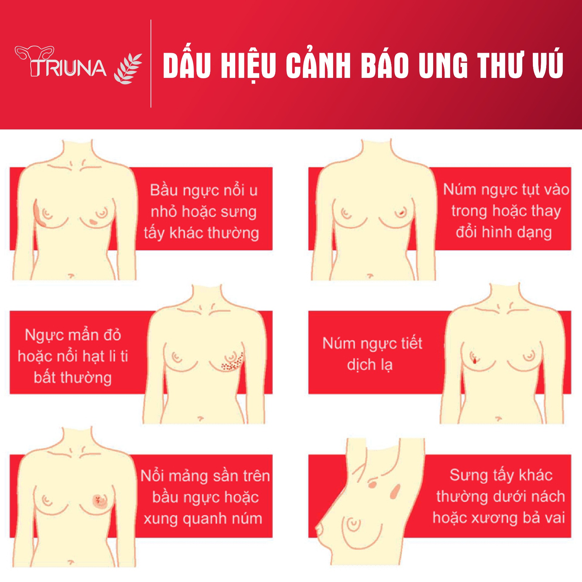 Dấu hiệu cảnh báo ung thư vú